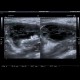 Inguinal hernia, laparoscopic repair, remained peritoneal sac with hematoma: US - Ultrasound